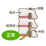 正常な腰椎椎間板　Normal lumbar vertebra intervertebral disk
